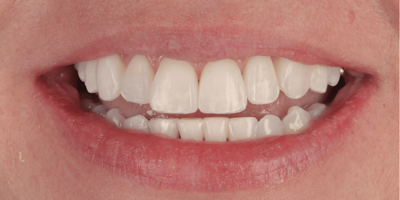 After - Rochester Lodge Dental